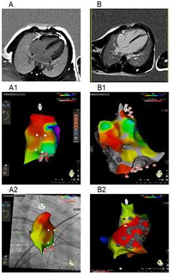 Case Reports: Emery-Dreifuss Muscular Dystrophy Presenting as a Heart Rhythm Disorders in Children